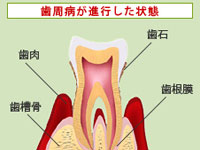 歯周病が進行した状態